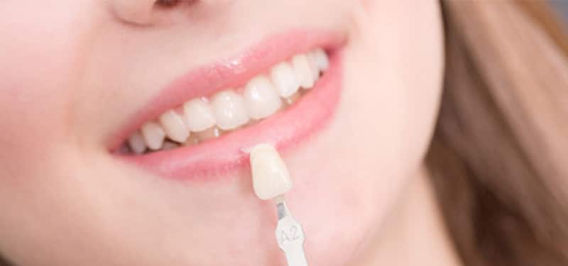 How Much Do Porcelain Veneers Cost